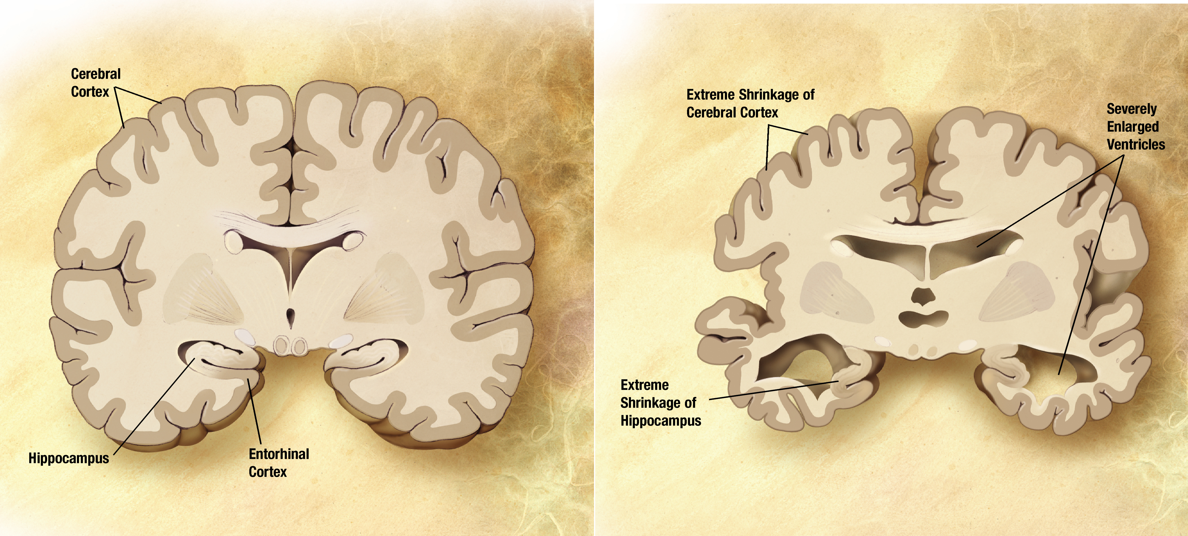 Is The Incidence Of Alzheimer S Increasing