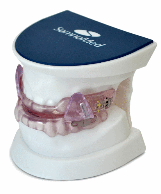 Retrognathia and the use of a Mandibular Advancement Splint (MAS) to ...