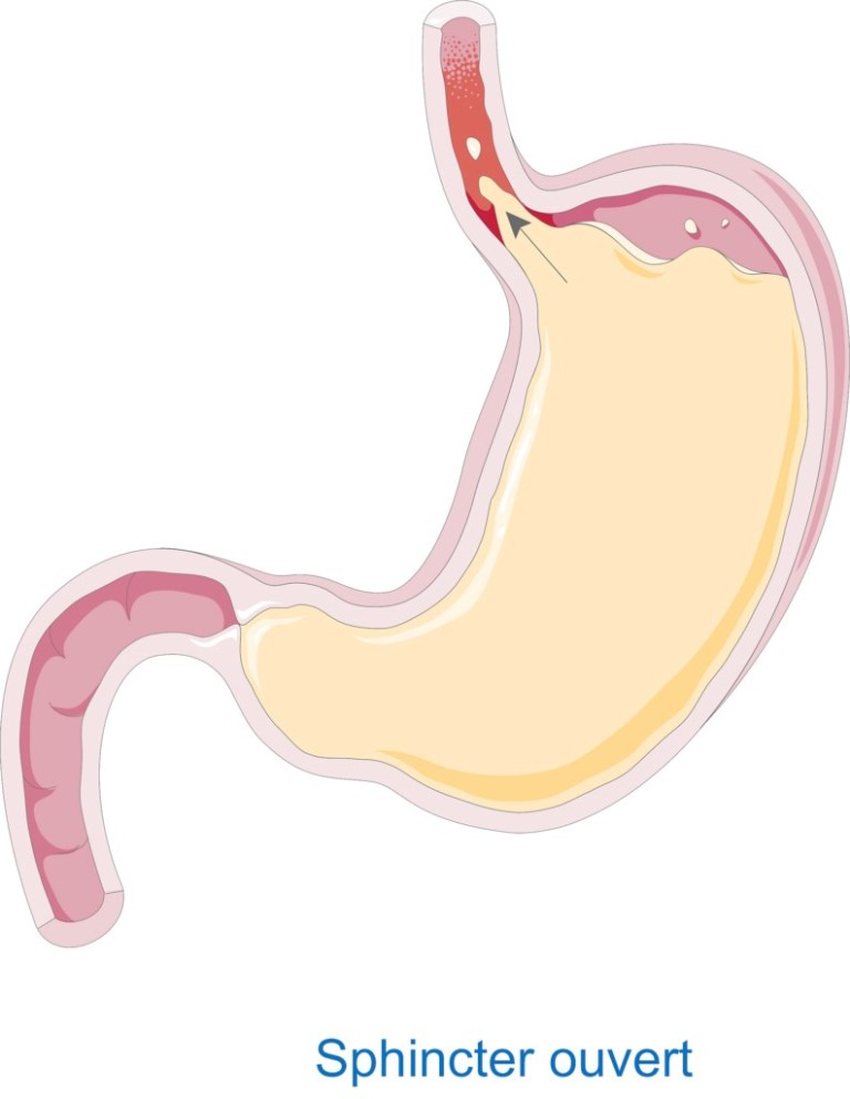 Sleep related Gastroesophageal Reflux - Thoracic and Sleep Group Queensland