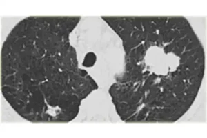photo_lungcancer_nsclc