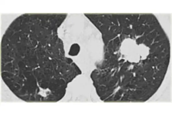 photo_lungcancer_nsclc