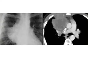 photo_mediastinalmass