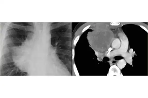 photo_mediastinalmass