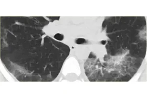 photo_pulmonaryfibrosis_2