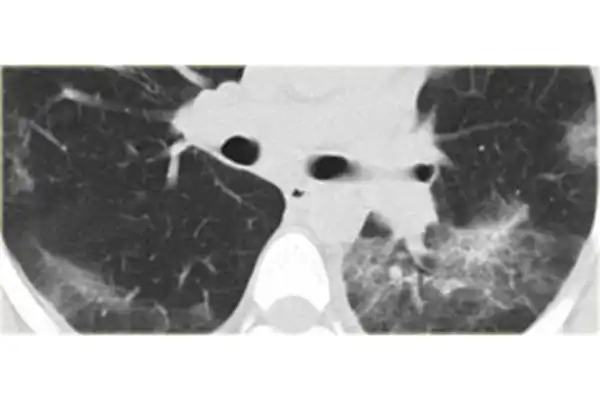 photo_pulmonaryfibrosis_2